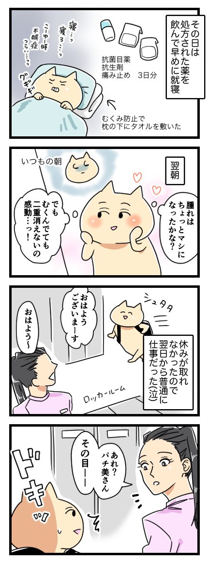 二重なのに埋没法をした話